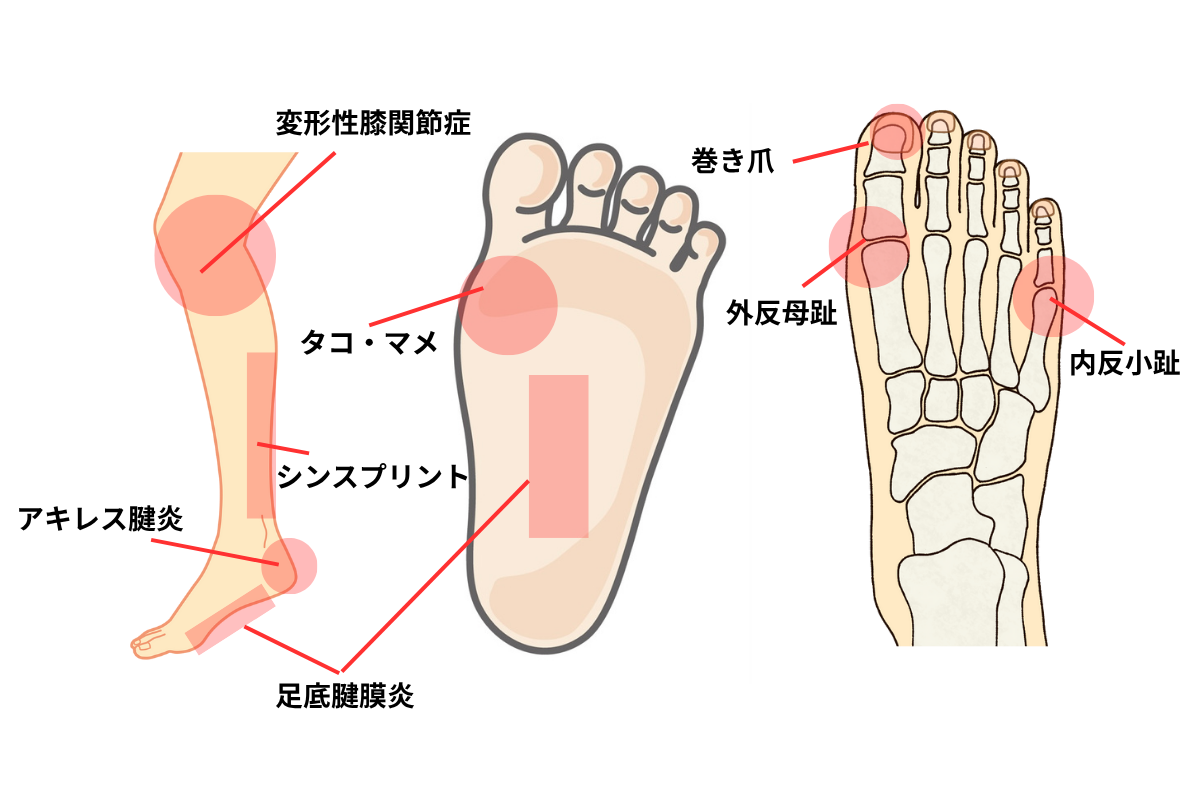 膝や足の適応症状図解
