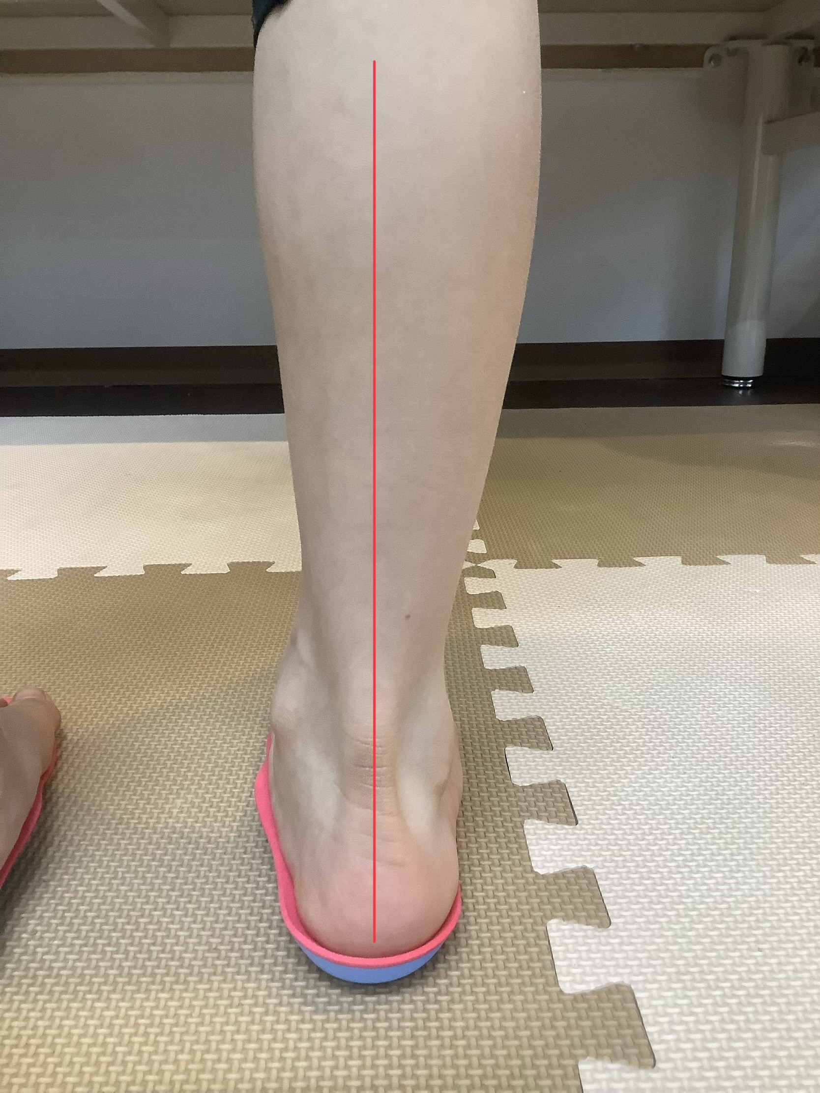 インソールで足首の軸が垂直に整った状態